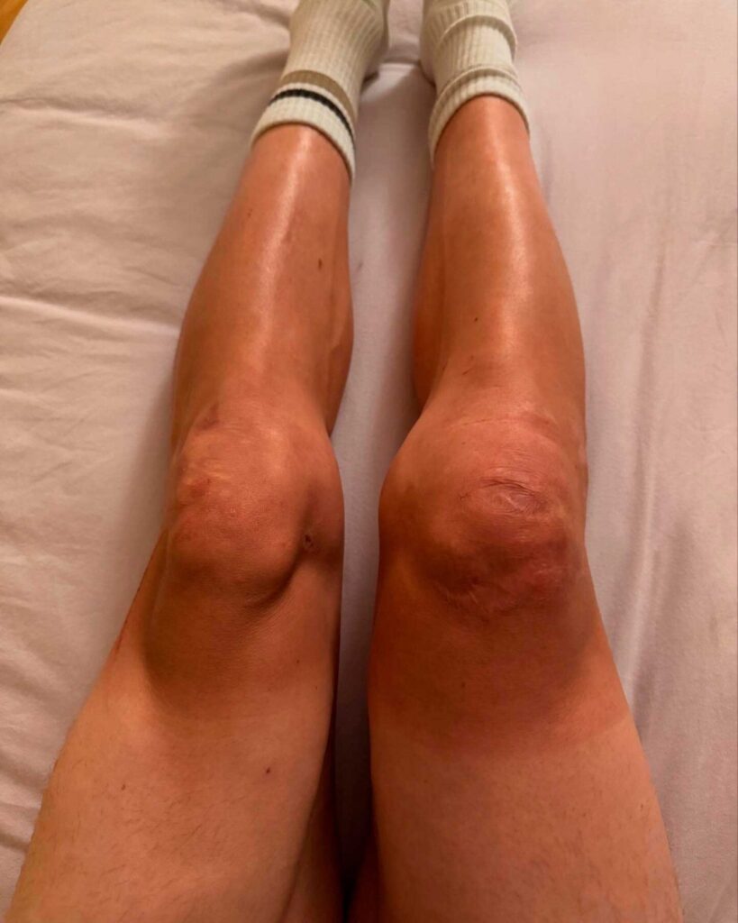 Thomas Pidcock Infortunio Catalunya